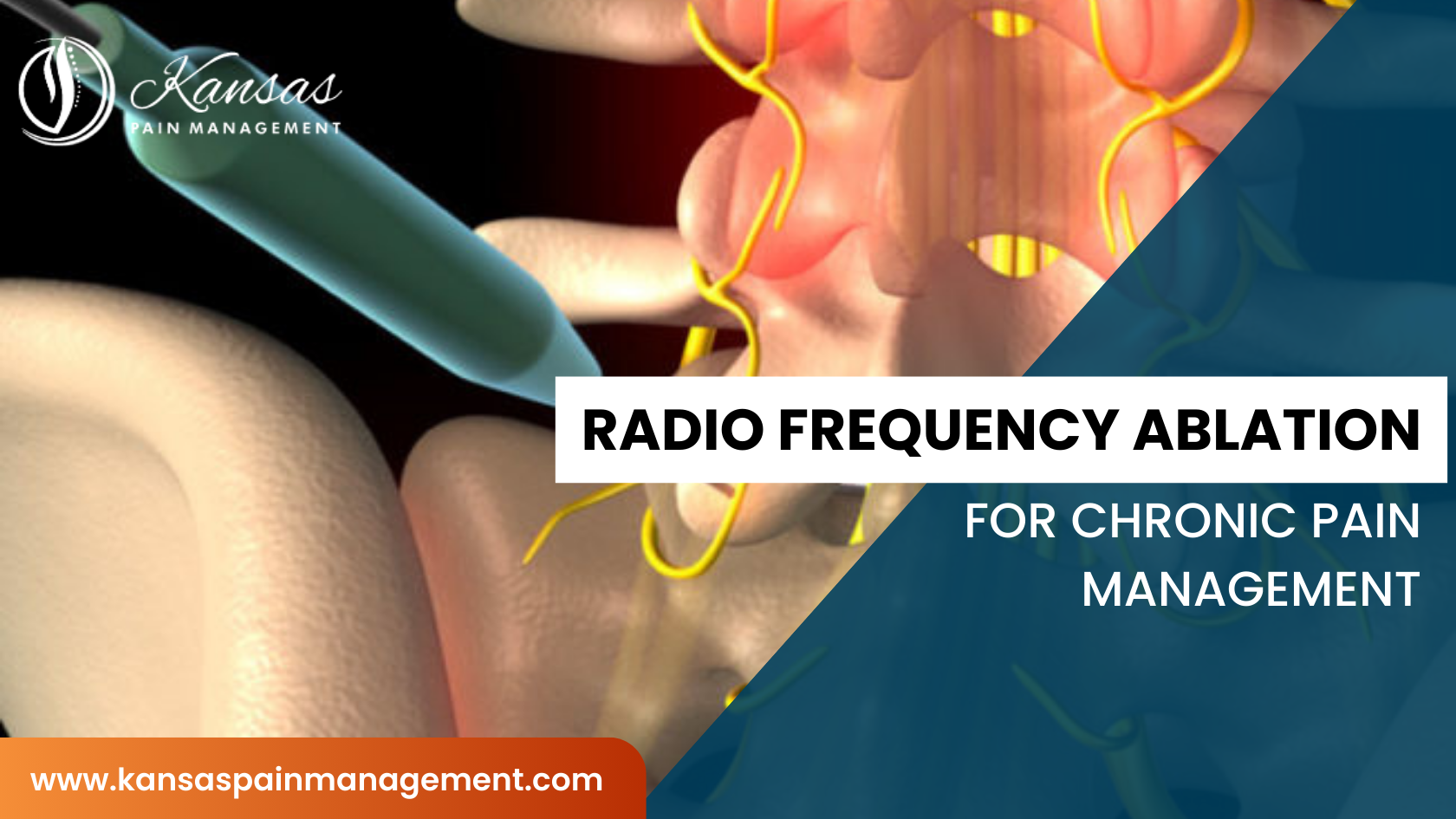 Radio frequency Ablation for Pain Management – Overland Park