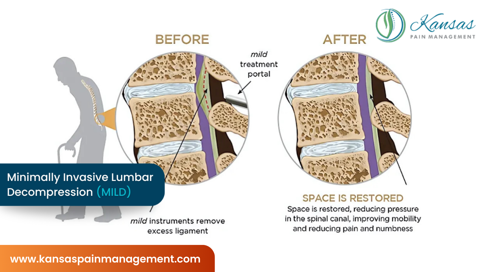 Avoid or Delay Back Surgery with Interventional Pain Management