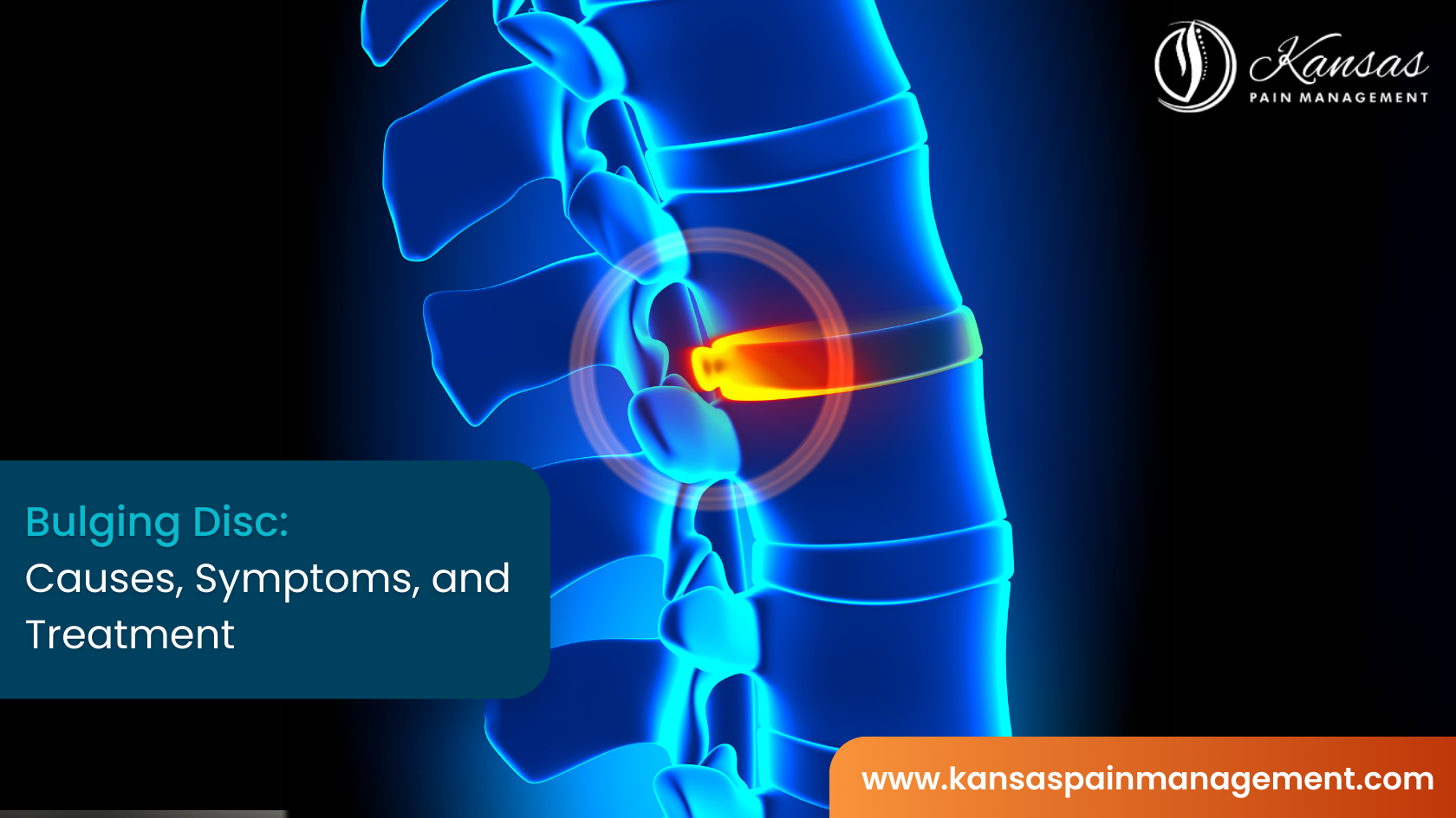 Bulging Disc_ Causes, Symptoms, and Treatmen