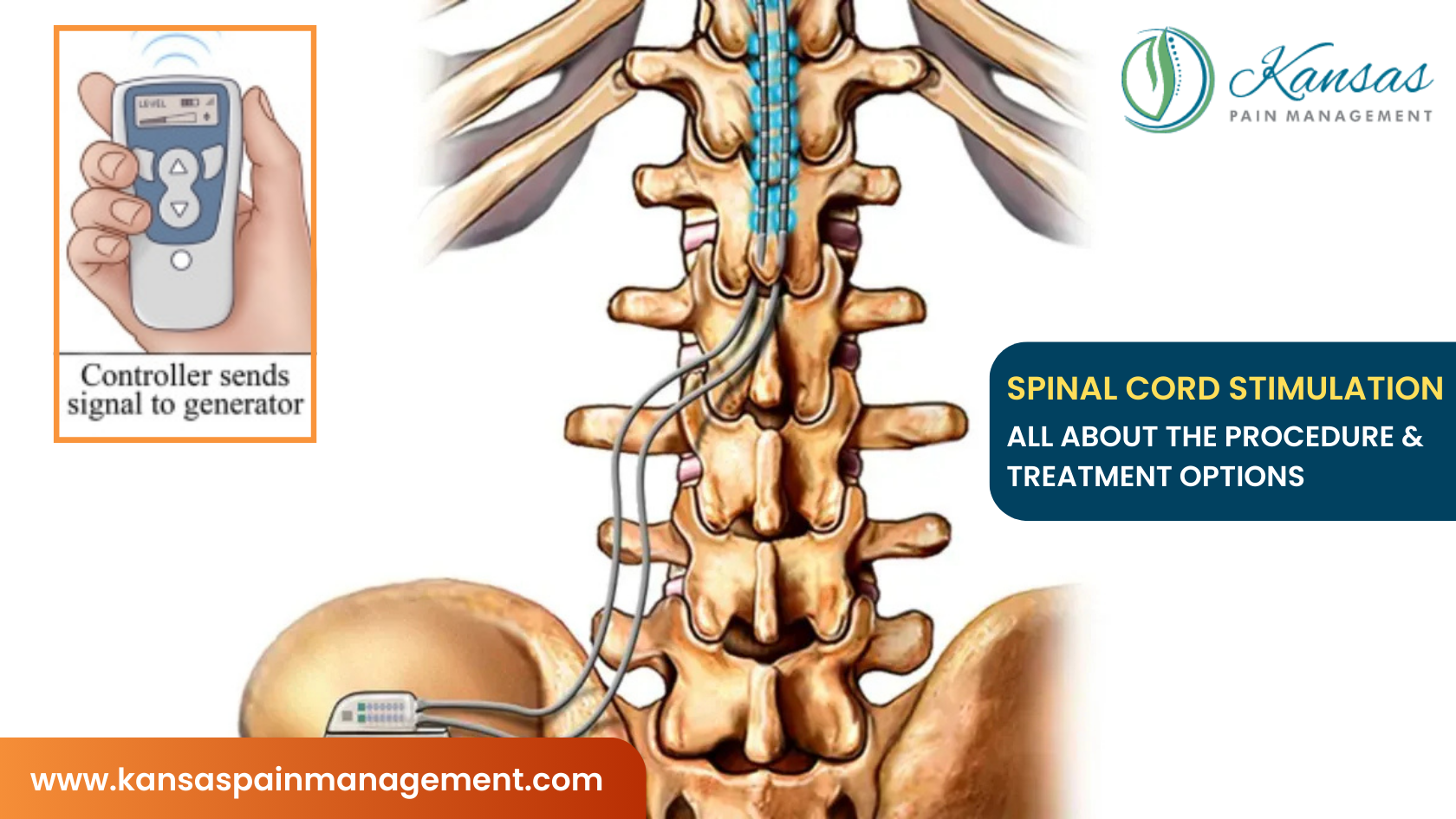 Spinal Cord Stimulation for chronic pain