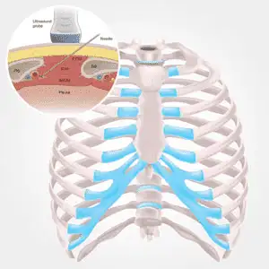Intercostal-Nerve-Block
