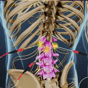 Lumbar-Radiofrequency-Neurotomy