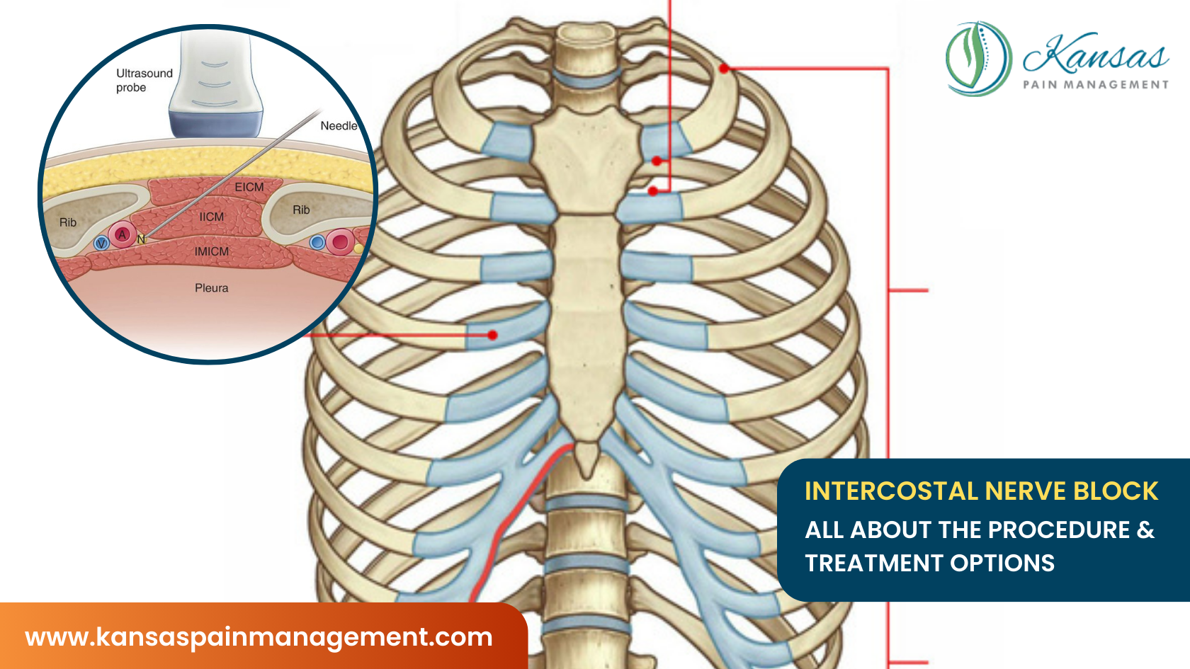 Intercostal Nerve Block