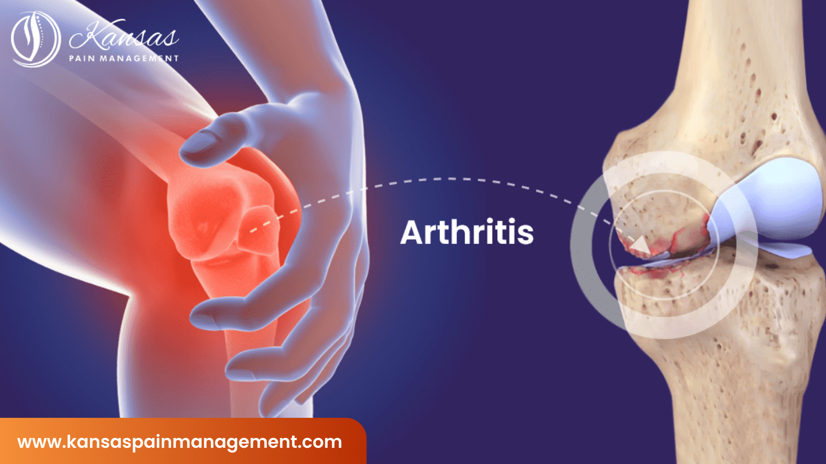 Arthritis