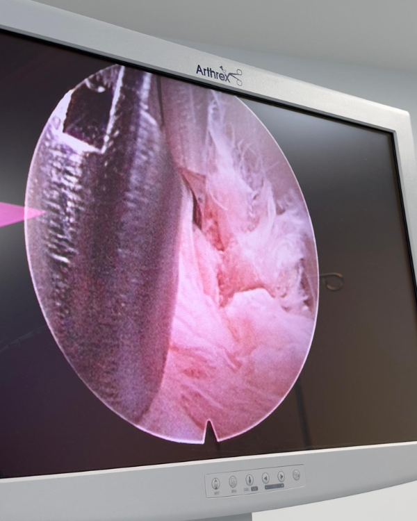 Minimally Invasive Discectomy-img4