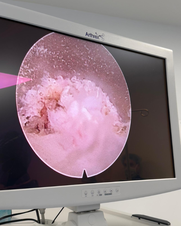 Minimally Invasive Discectomy-img5