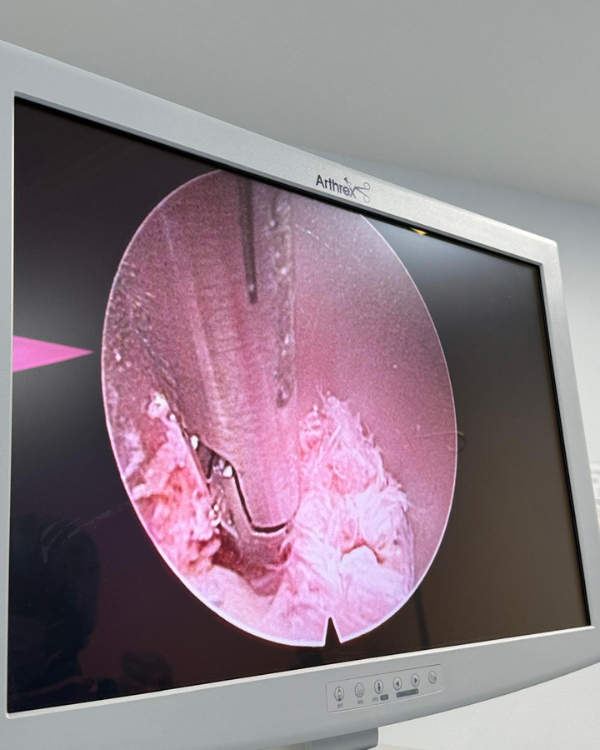 Minimally Invasive Discectomy-img6