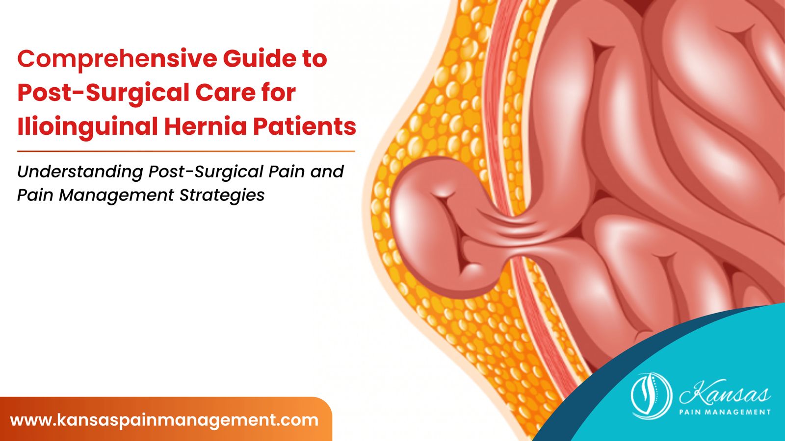 Post-Surgical Care for Ilioinguinal Hernia Patients