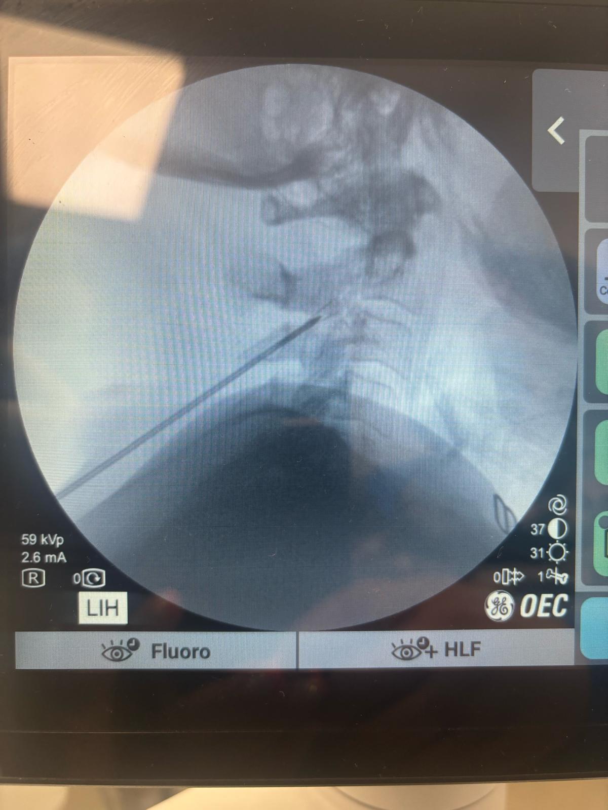 Occipital Neuralgia