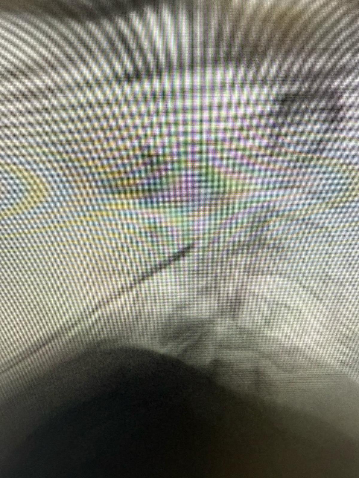 Occipital Neuralgia