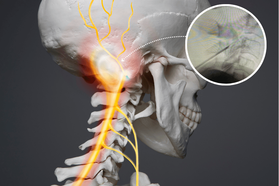 Third Occipital Nerve Radiofrequency Ablation (RFA)