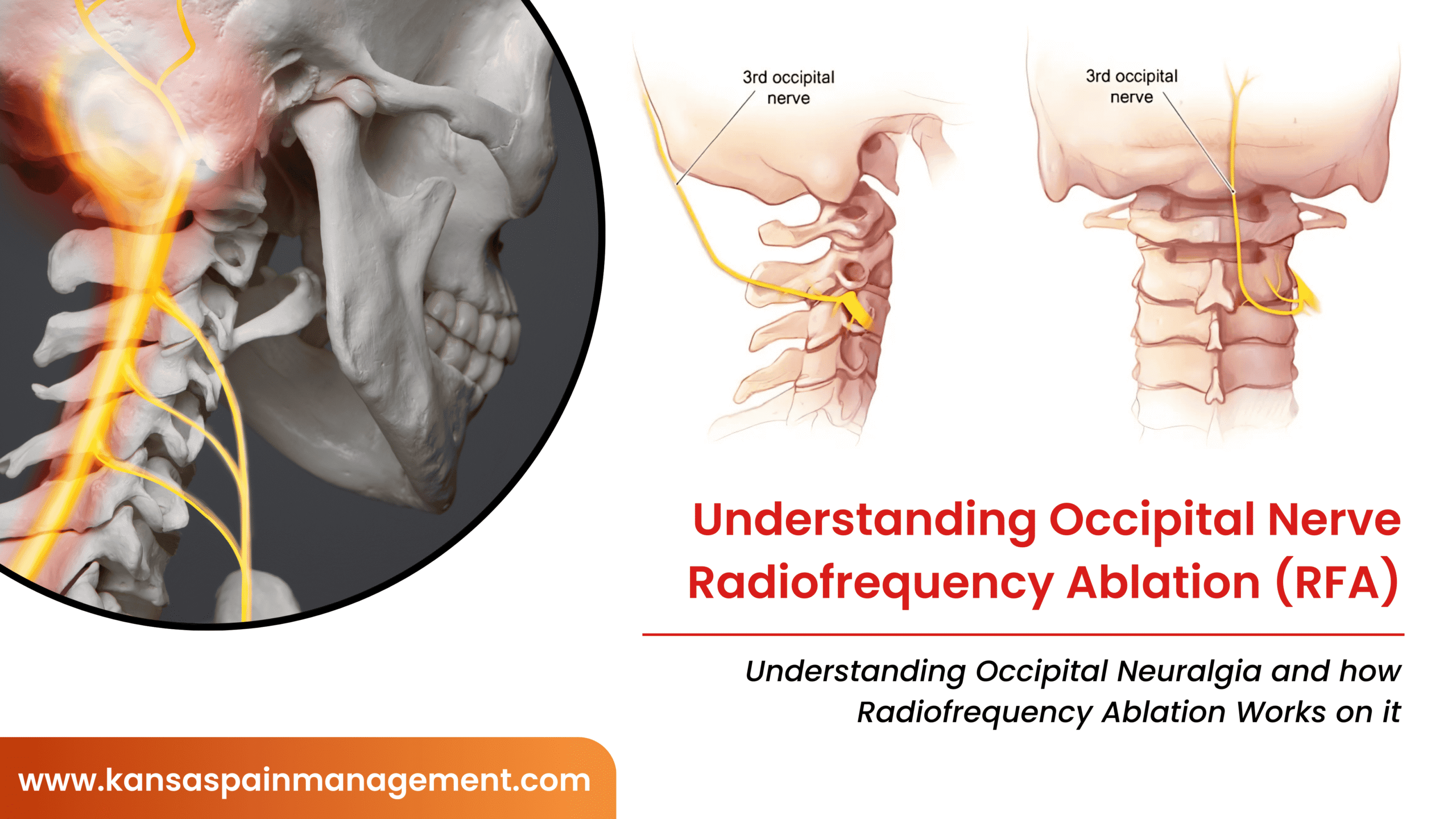 Understanding-Occipital-Nerve-Radiofrequency-Ablation-RFA