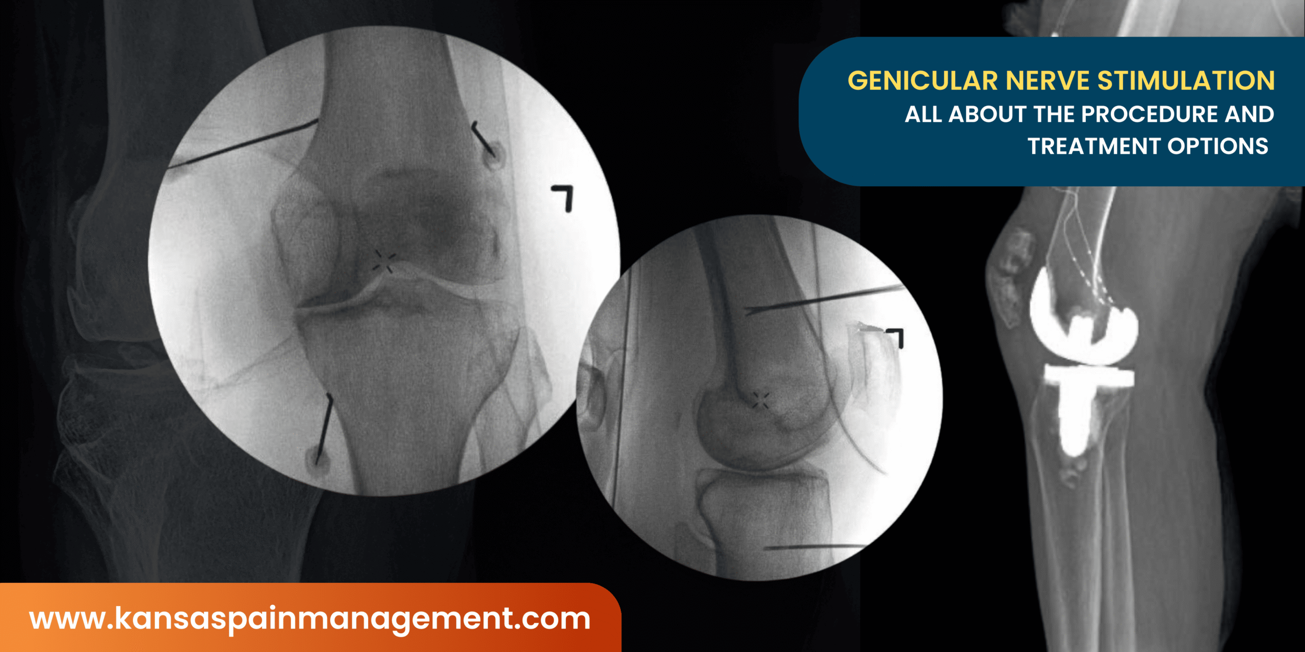 Genicular Nerve Stimulation-