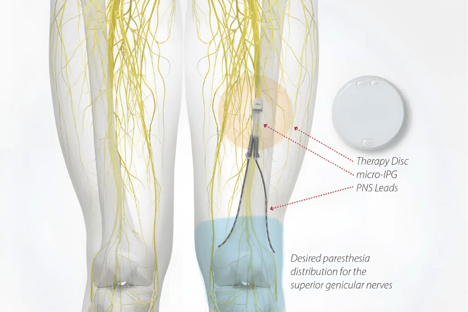 Genicular Nerve Stimulator