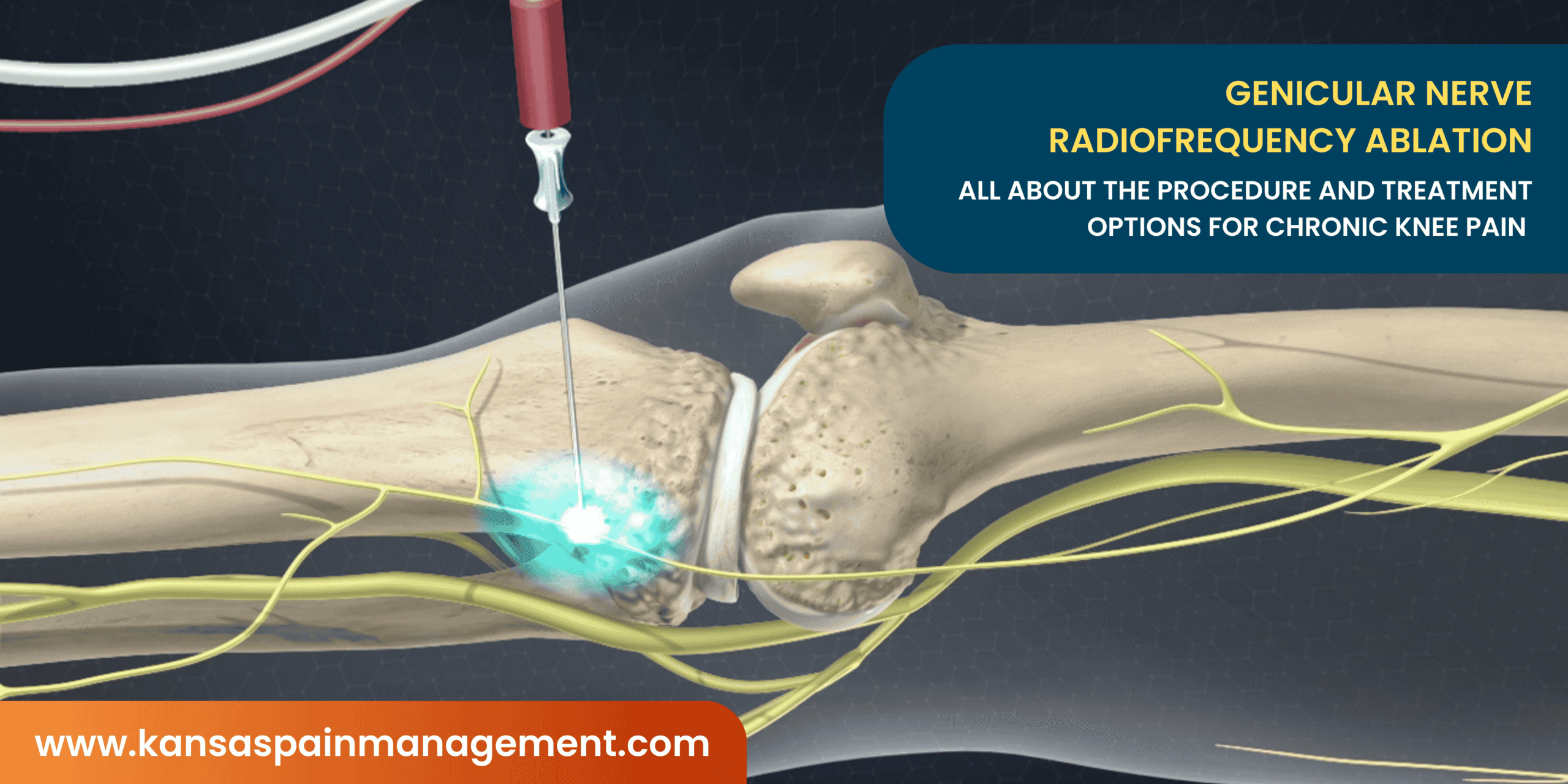 Genicular nerve radiofrequency ablation