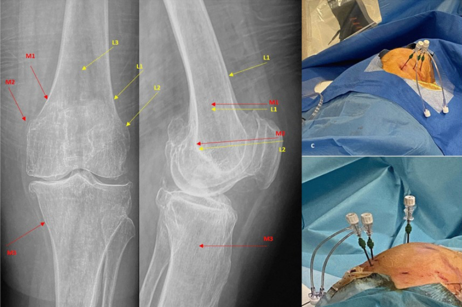 ⁠⁠Genicular Radiofrequency Ablation (RFA) for Chronic Knee Pain