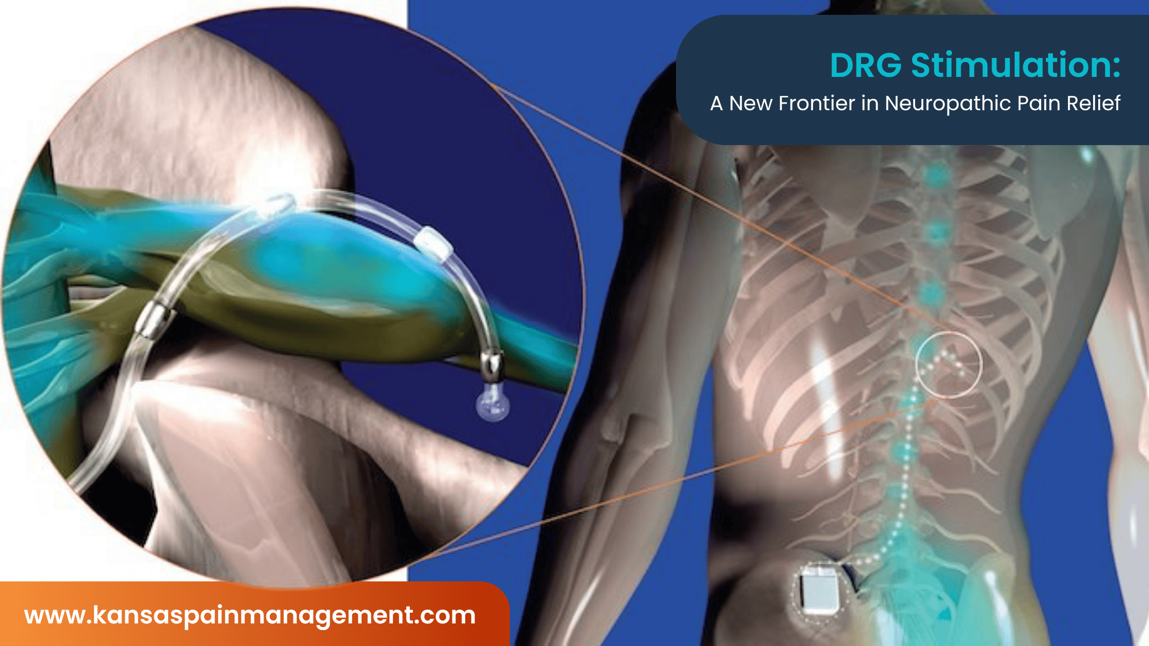 DRG Stimulation A New Frontier in Neuropathic Pain Relief